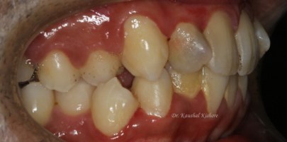 Progressive Digital Orthodontics caso Kishore 1