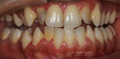 Progressive Digital Orthodontics caso Kishore 2