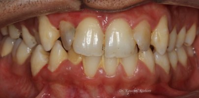 Progressive Digital Orthodontics caso Kishore 4